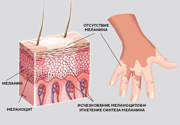 витилиго.jpg