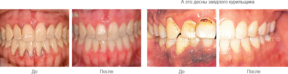 До или после чистки зубов ирригатором